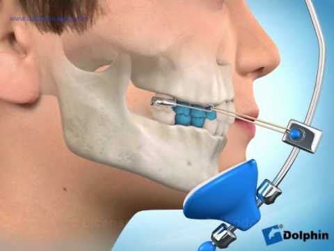 sau khi sử dụng hàm face mash