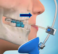 hàm face mash kéo hàm trên ra trước