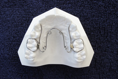 hàm nắn chỉnh nha khoa Quardhelix