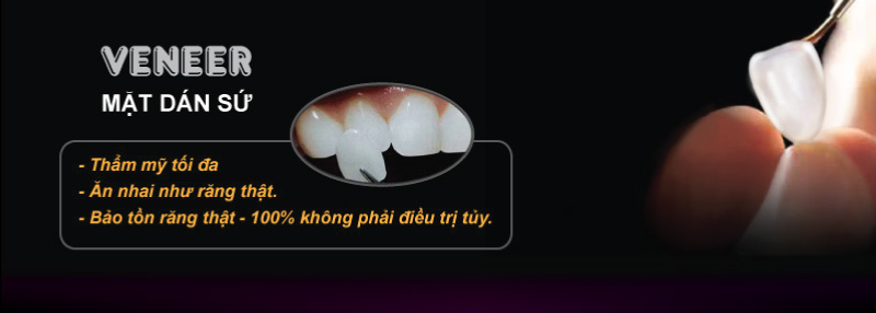 mặt dán sứ Veneer