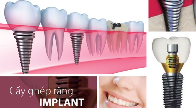 Biểu hiện viêm quanh implant ở bệnh nhân cấy ghép implant