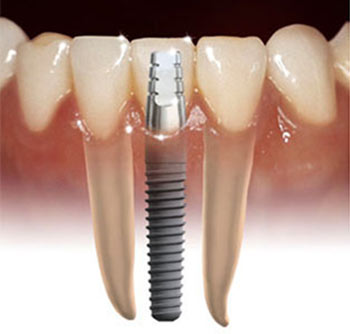 Chăm sóc răng miệng người có mang phục hình
