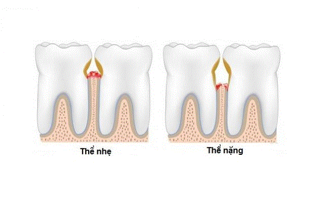 Chớ xem thường bệnh viêm lợi